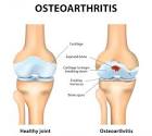 Stages of Osteoarthritis of the Knee